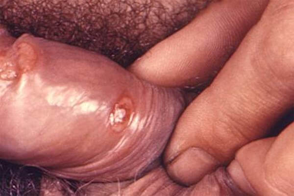 Anzeichen Syphilis Infektion