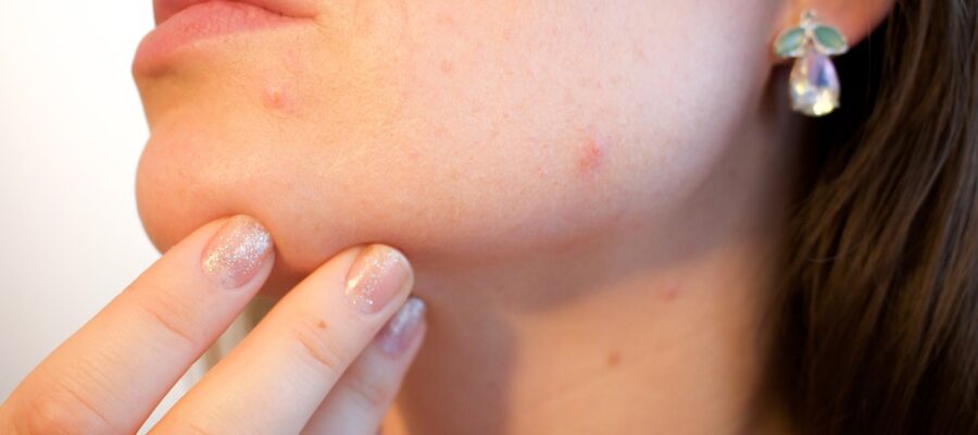 Tipps gegen unreine Haut